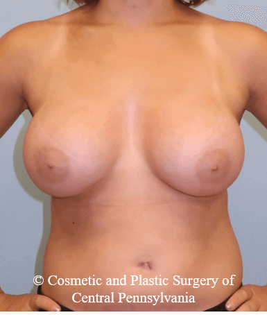 Breast Augmentation After