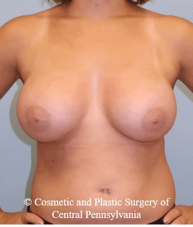 Breast Augmentation After