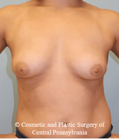 Breast Augmentation Before