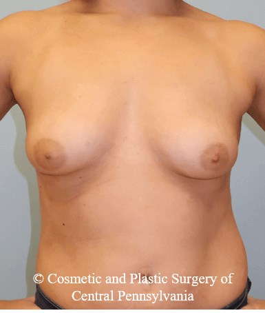 Breast Augmentation Before