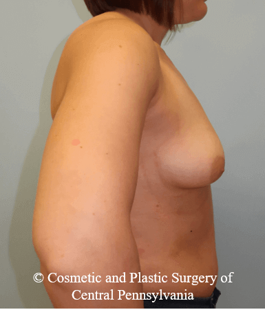 Breast Augmentation Before