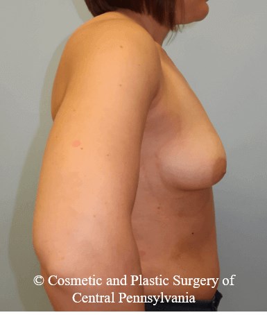 Breast Augmentation Before