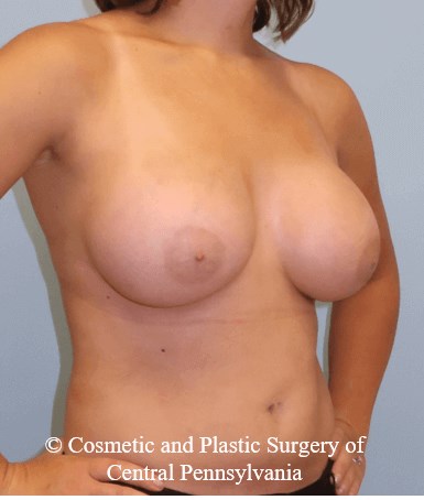 Breast Augmentation After