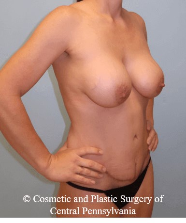 Mommy Makeover After