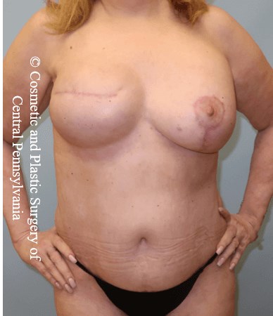 Breast Recon rev & Tummy Tuck After