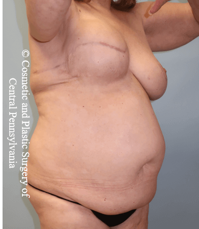 Breast Recon rev & Tummy Tuck Before