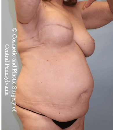 Breast Recon rev & Tummy Tuck Before