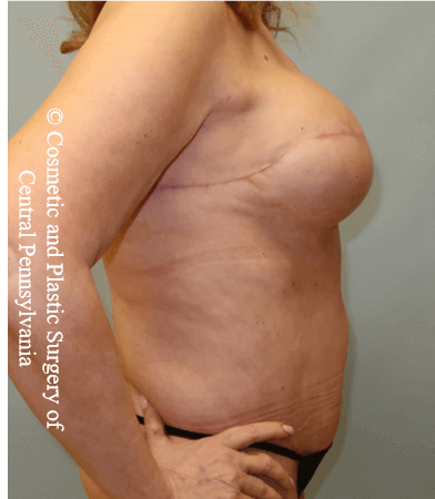 Breast Recon rev & Tummy Tuck After