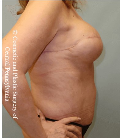 Breast Recon rev & Tummy Tuck After