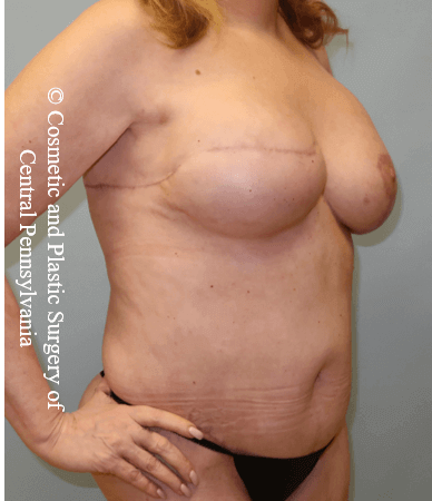 Breast Recon rev & Tummy Tuck After