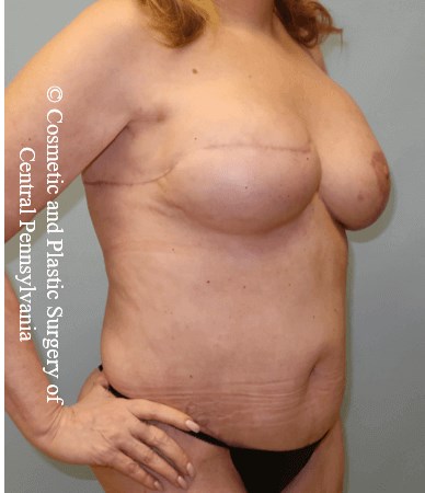 Breast Recon rev & Tummy Tuck After