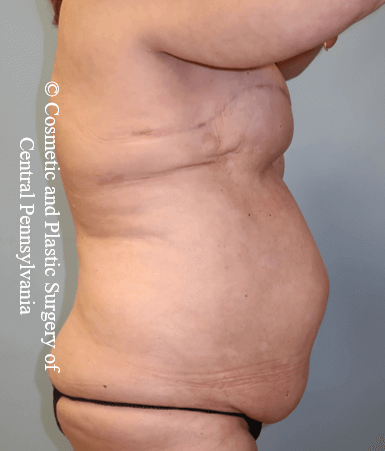 Breast Recon rev & Tummy Tuck Before