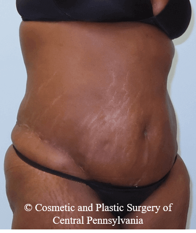 Abdominoplasty After