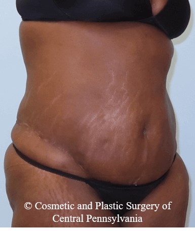 Abdominoplasty After