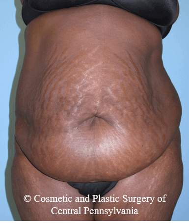 Abdominoplasty Before