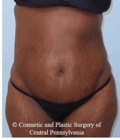 Abdominoplasty After