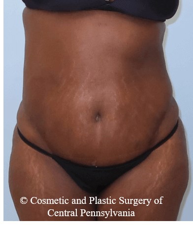 Abdominoplasty After