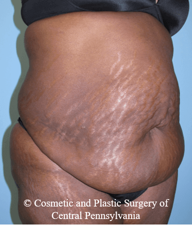Abdominoplasty Before