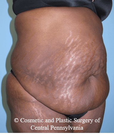 Abdominoplasty Before