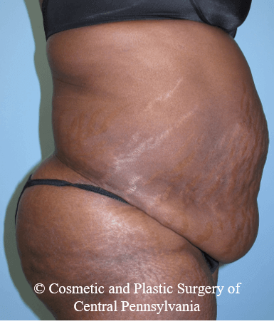 Abdominoplasty Before