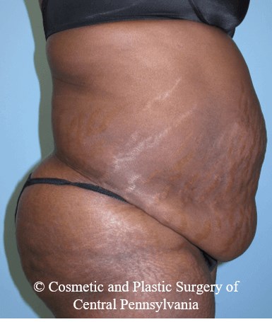 Abdominoplasty Before