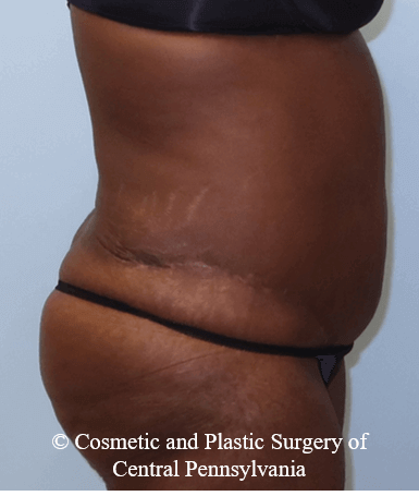 Abdominoplasty After