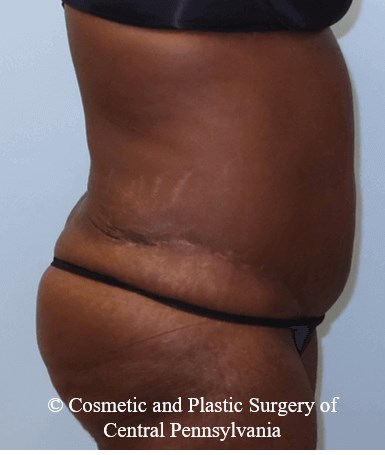 Abdominoplasty After