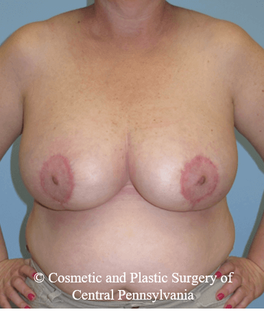 Breast Reduction After