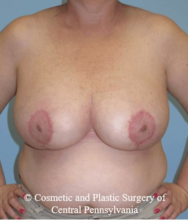 Breast Reduction After