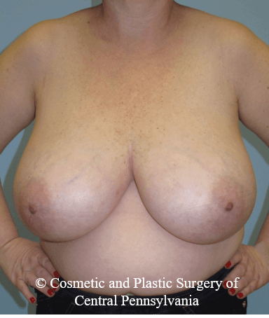 Breast Reduction Before