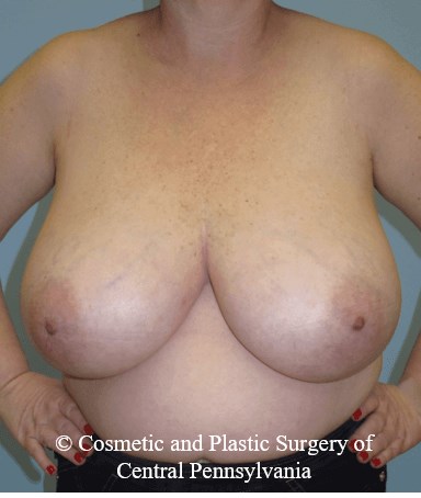 Breast Reduction Before