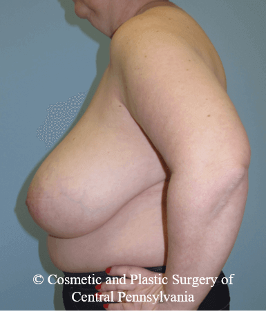 Breast Reduction Before
