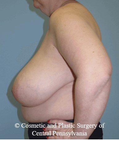 Breast Reduction Before