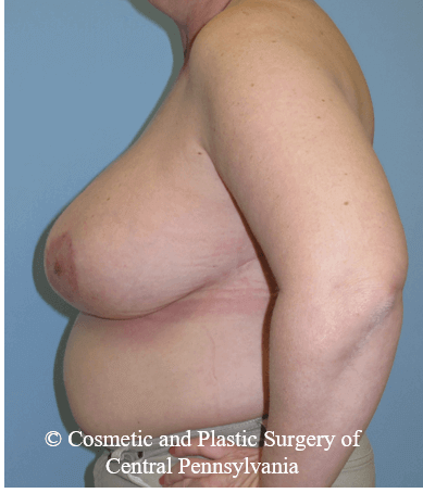 Breast Reduction After
