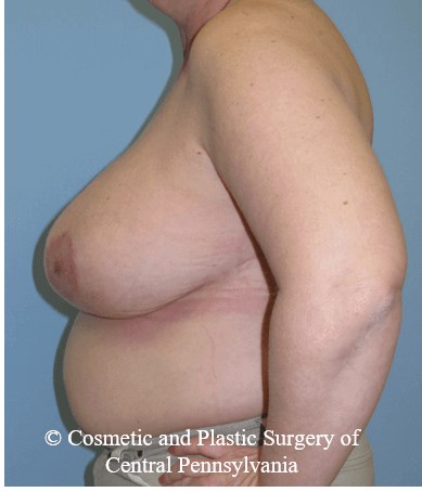 Breast Reduction After