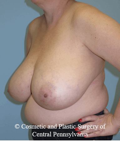 Breast Reduction Before