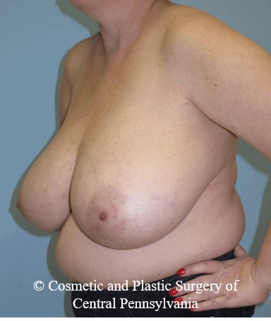 Breast Reduction Before