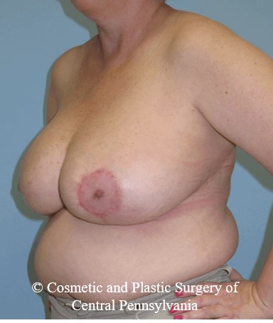 Breast Reduction After