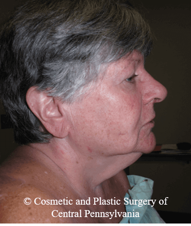 Neck Lift Before