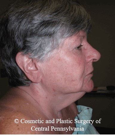 Neck Lift Before