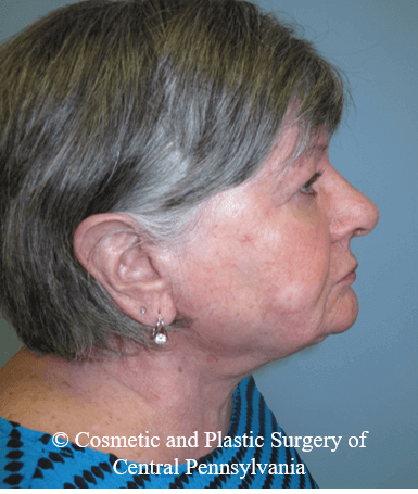 Neck Lift After