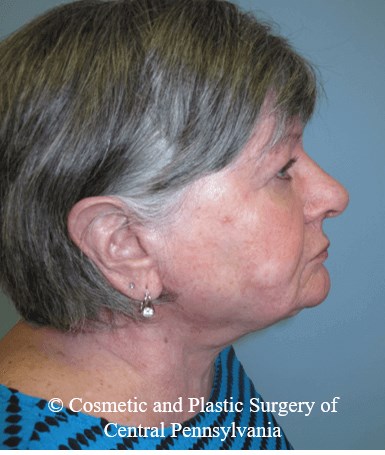 Neck Lift After