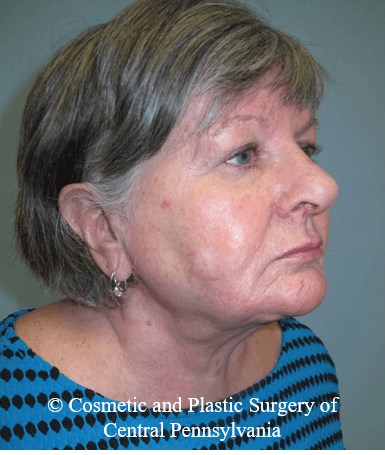 Neck Lift After
