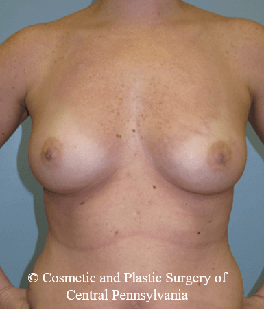 Breast Reconstruction Before