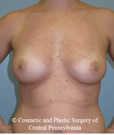 Breast Reconstruction Before