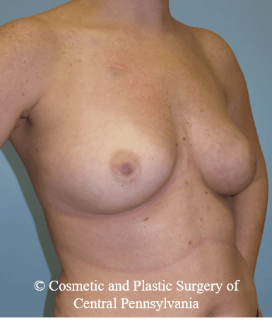 Breast Reconstruction Before