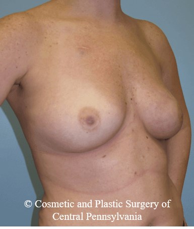 Breast Reconstruction Before