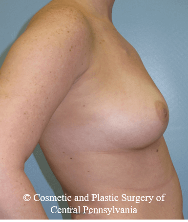 Breast Reconstruction Before