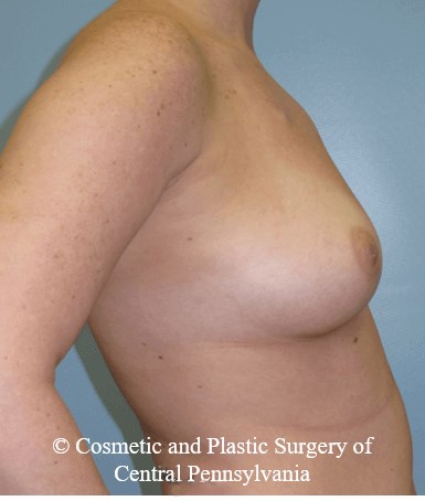 Breast Reconstruction Before