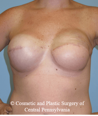 Breast Reconstruction After